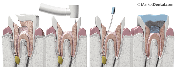 Root Canal Treatment Kemptville
