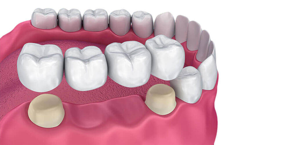 Dental Bridges Kemptville