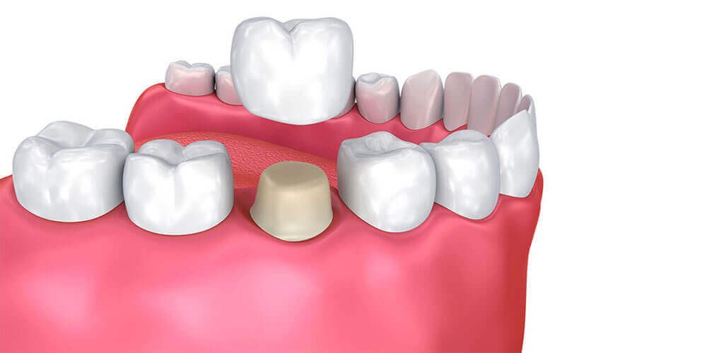 Dental Crowns Kemptville