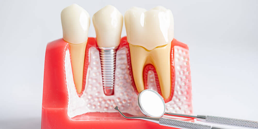 Dental Implants Kemptville