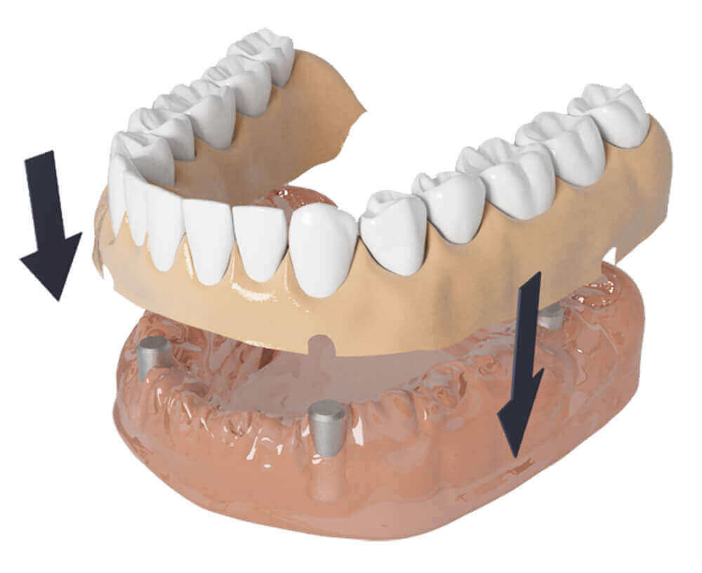 Implant Supported Dentures Kemptville