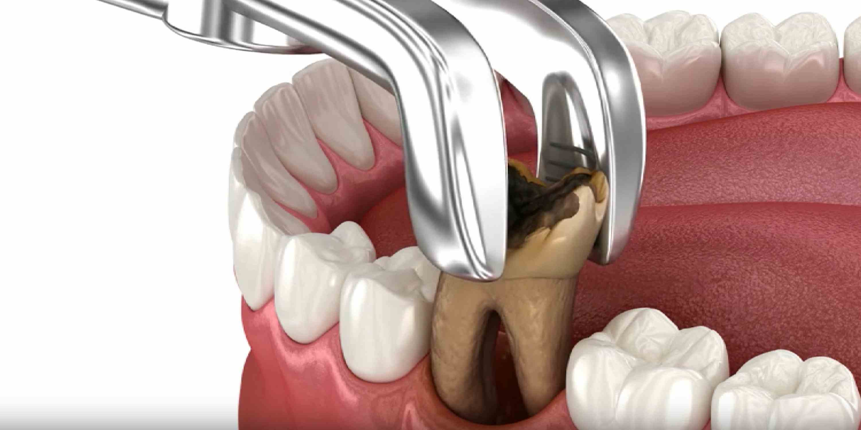 Post-Operative Tooth Extraction Instructions